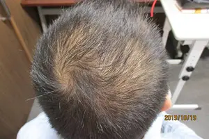 AGA治療実績症例写真②頭頂部内服開始前