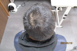 AGA治療症例写真②頭頂部内服1年3か月後