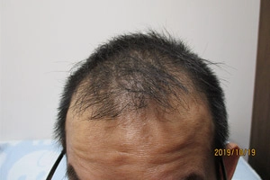 AGA治療症例写真③前頭部内服開始前