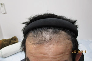 AGA治療症例写真③前頭部内服1年3か月後