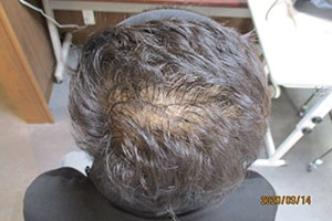 AGA治療実績①内服開始前の症例写真