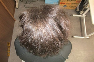 AGA治療実績①内服1年後の症例写真