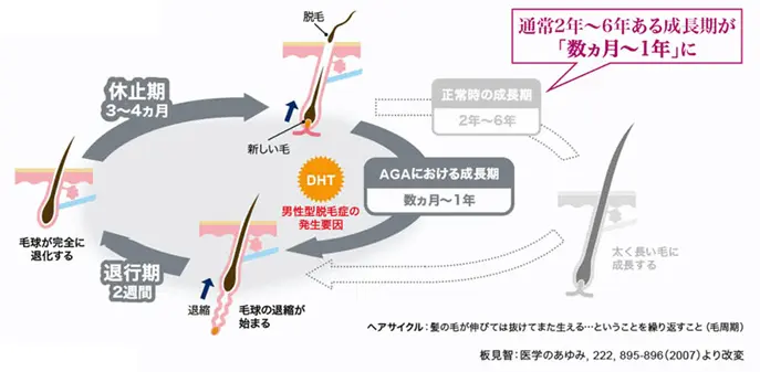 AGAのヘアサイクル