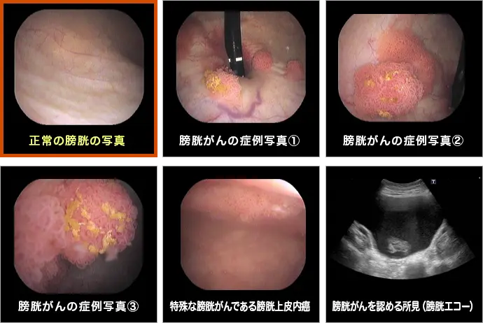 膀胱がんの症例写真