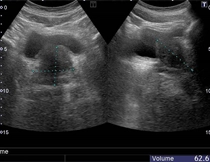 前立腺肥大症の症例写真