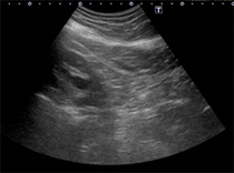 右腎エコー右水腎症