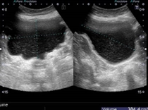 膀胱エコー残尿多量な状態