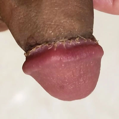 亀頭直下切除法症例①術後6日目
