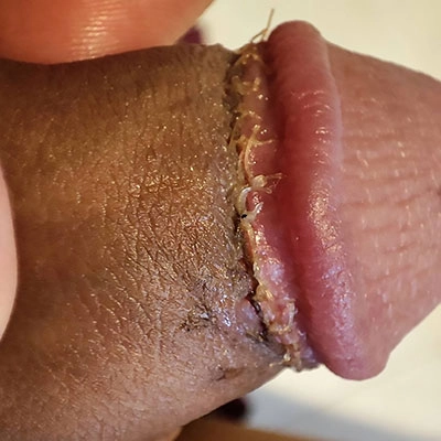 亀頭直下切除法症例①術後10日目