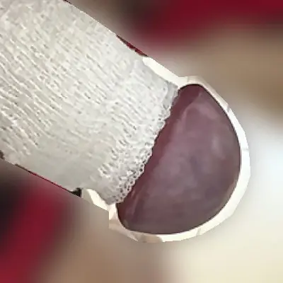 亀頭直下切除法症例②術後当日