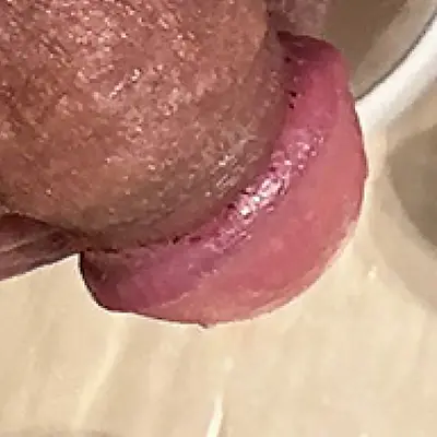 亀頭直下切除法症例②術後3日