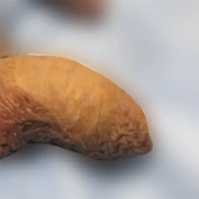 亀頭直下切除法症例③術前