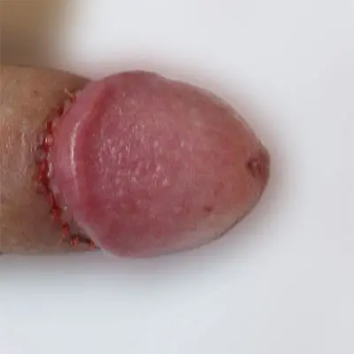 亀頭直下切除法症例③術後