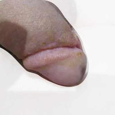 亀頭直下切除法症例④術後2週間目①