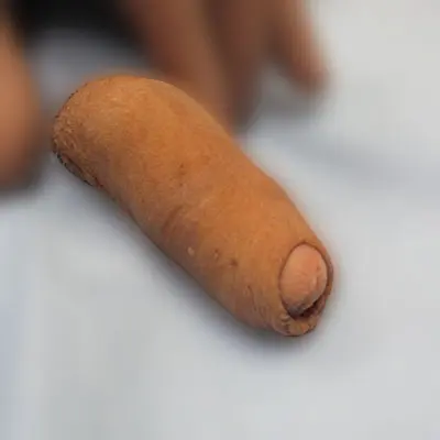 根部環状切開術症例写真①施術前