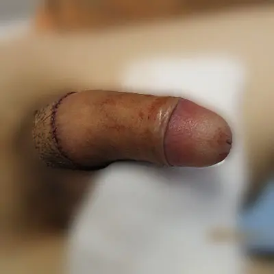 根部環状切開術症例写真①施施術前